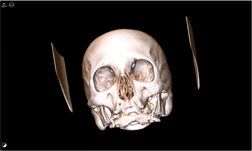 3D volume rendering